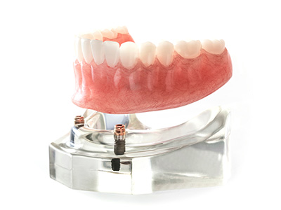 Implants Dentist in Springfield GA